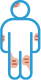 Icon of full body outline showing irritation or swelling in sweat glands. Please refer to list of full indications.