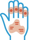 Icon of hand showing irritation or swelling in fingers and palm. Please refer to list of full indications.